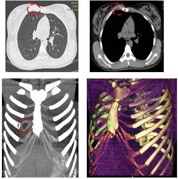 Tomografía multidectector corte axial, coronal y reconstrucción en 3D: Lesión única ocupante de espacio afectando cuarto cartílago derecho izquierdo expansiva, porción central hipodensa de comportamiento osteolítico, con remodelación, adelgazamiento y expansión de la cortical (círculo verde punteado).
