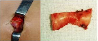 Toracotomía anterior derecha a nivel del 4to y 5to espacio intercostal con resección quirúrgica del cuarto cartílago costal con su desarticulación condrocostal. Lecho quirúrgico después de resecado el tumor