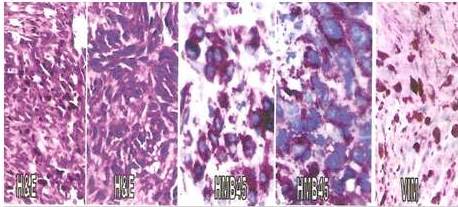 Diagn&oacute;stico: melanoma maligno.