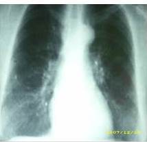 RX de t&oacute;rax 15/07/08. Estudio normal.