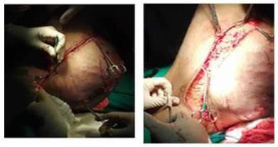 Incisi&oacute;n longitudinal en cara posterolateral externa,  con confecci&oacute;n de colgajo fasciocut&aacute;neo y biopsia trans-operatoria de bordes de piel, reportados como negativoa de malignidad