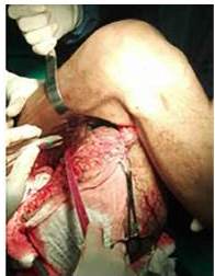 Secci&oacute;n de tejido muscular respewtando 1 cm de margen de tejido sano a trav&eacute;s de vasto lateral de cu&aacute;dripceps femoral hasta alcanzar plano &oacute;seo e identificaci&oacute;n del nervio ci&aacute;tico 