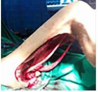 Lecho quir&uacute;rgico pos-resecci&oacute;n tumoral. Se aprecia  nervio ci&aacute;tico (A) y M. Gracilis (B)