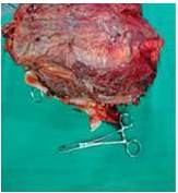 Lesi&oacute;n tumoral.