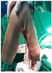 Avance de colgajos fascio-cut&aacute;neos de la cara antero-laterales interno y externo para cierre de defecto, previa colocaci&oacute;n de 2 ramas de drenaje aspirativo de &frac14;