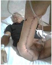 Aspecto del cierre del defecto en su posoperatorio inmediato 24 h