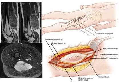 Representaci&oacute;n de lesiones en compartimiento posterior del muslo susceptibles a resecci&oacute;n compartamental cl&aacute;sica. C y D Abordaje cl&aacute;sico de resecci&oacute;n del compartimiento posterior del muslo (5)
