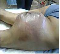 Paciente en dec&uacute;bito prono, tumoraci&oacute;n de gran tama&ntilde;o