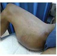 Paciente en dec&uacute;bito supino, visualizaci&oacute;n de la lesi&oacute;n cara lateral interna