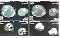 RMN de muslo derecho, LOE afectando tercio proximal y medio de muslo