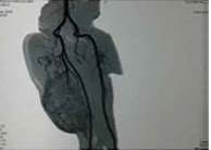 Angiotac de miembros inferiores, visi&oacute;n lateral, se evidencia no muy bien definida zona de clivaje y vascularizaci&oacute;n del tumor por arteria femoral profunda