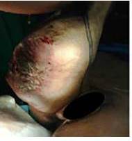 Tumor de gran tama&ntilde;o 30 cm x 20 cm, altamente vascularizado, ulcerado, con cicatriz hipertr&oacute;fica de cirug&iacute;a anterior de 10 cm. Sin infiltraci&oacute;n de vasos femorales, nervio ci&aacute;tico. Lesiones nodulares de 1,5 cm en fosa popl&iacute;tea