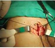 Incisi&oacute;n longitudinal inguinal derecha disecci&oacute;n hasta identificaci&oacute;n de paquete vascular femoral con ligadura de arteria femoral profunda,