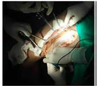 Incisi&oacute;n longitudinal en cara posterolateral interna,con confecci&oacute;n de colgajo fasciocut&aacute;neo y biopsia trans operatoria de bordes de piel, reportados por anatom&iacute;a patol&oacute;gica como negativos de malignidad