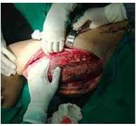 Secci&oacute;n de tejido muscular, respetando 1 cm de margen de tejido sano, con disecci&oacute;n y preservaci&oacute;n del m&uacute;sculo Gr&aacute;cilis y Sartorio