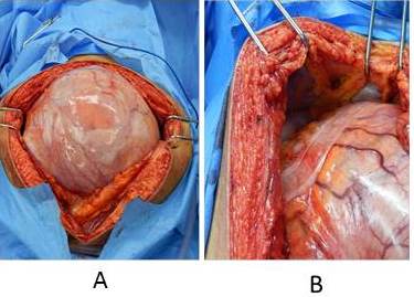 Resecci&oacute;n de la lesi&oacute;n