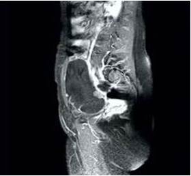 Imagen de resonancia magn&eacute;tica que demuestra la tumoraci&oacute;n de origen anexial anterolateral al &uacute;tero.