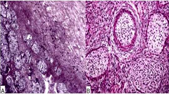 Microfotograf&iacute;a del tumor de Brenner maligno en la que observan: A) zonas uniformes de c&eacute;lulas epiteliales invadiendo en un estroma fibroso denso y B) islotes de c&eacute;lulas tumorales en zonas bien demarcadas. Coloraci&oacute;n de hematoxilina y eosina.