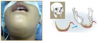 A. Imagen preoperatoria de la lesi&oacute;n. B. Tipo del defecto