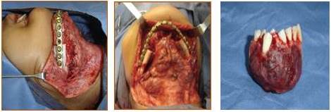 Pieza quir&uacute;rgica