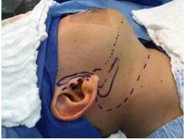 Reconstrucci&oacute;n del defecto