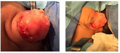 Pieza quir&uacute;rgica