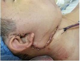 Paciente en posoperatorio inmediato