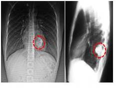 Radiograf&iacute;a de t&oacute;rax: defecto localizado en el &aacute;ngulo interno del d&eacute;cimo (10o) arco costal izquierdo, de aspecto l&iacute;tico con aparente abombamiento del periostio y perdida de sustancia &oacute;sea (pompas de jab&oacute;n).