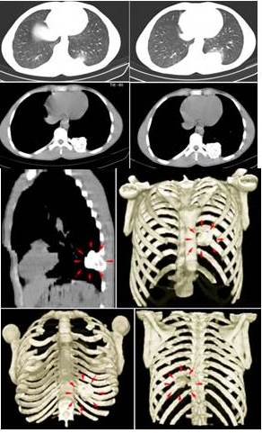 Tomograf&iacute;a de t&oacute;rax multi-detector corte axial y con reconstrucci&oacute;n 3D: lesi&oacute;n &uacute;nica ocupante de espacio afectando d&eacute;cimo (10o) arco costal posterior izquierdo, hiperdensa con &aacute;reas hipodensas en su interior, redondeada de bordes bien definidos micro-lobulados que mide 4,3 cm x 4,3 cm a nivel del 1/3 proximal expansiva, porci&oacute;n central hipodensa de comportamiento osteol&iacute;tico, con remodelaci&oacute;n, adelgazamiento y expansi&oacute;n de la cortical (flechas roja).