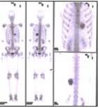 Survey &oacute;seo: lesi&oacute;n ocupante de espacio con aumento importante en la actividad de concentraci&oacute;n del radio-trazador proyectado en hemit&oacute;rax izquierdo, a la altura del d&eacute;cimo arco costal (10o) arco costal posterior izquierdo, con importante actividad expansiva y deformante
