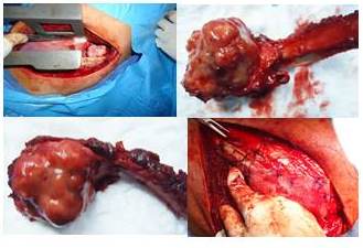 Toracotom&iacute;a p&oacute;stero lateral izquierda tor&aacute;cica a nivel del 9o espacio intercostal con resecci&oacute;n quir&uacute;rgica de los 2/3 proximales del 10o arco costal posterior izquierdo con su desarticulaci&oacute;n costo-vertebral. Se procedi&oacute; a la reconstrucci&oacute;n del defecto de pared tor&aacute;cica con colocaci&oacute;n de malla de monofilamento de polipropileno Marlex &reg;. 