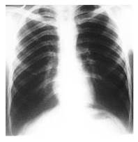 Radiograf&iacute;a de t&oacute;rax p&oacute;stero-anterior: tres meses despu&eacute;s de operado se aprecia ausencia del 10o arco costal izquierdo.