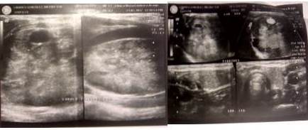 Ecosonograma de tiroides bilateral el cual report&oacute; bocio gigante en l&oacute;bulo tiroideo derecho