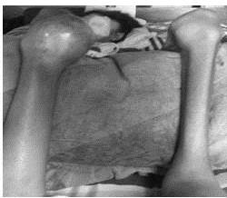 M Inferior Izquierdo aumento de volumen