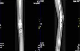 Hallazgo sugestivo de osteosarcoma o sarcoma de Ewing