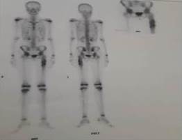 El gammagrama &oacute;seo que reporta reacci&oacute;n osteobl&aacute;stica en el f&eacute;mur izquierdo