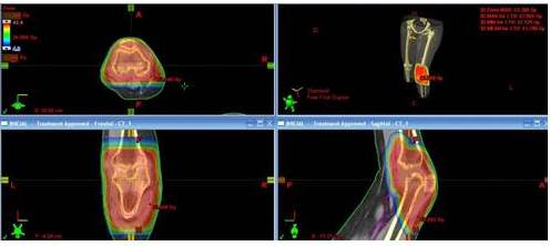 Distribuci&oacute;n porcentual de la dosis indicada por las diferentes tonalidades de colores cuyos valores se pueden observar en la columna de superior izquierda, en los planos axial, coronal y sagital.