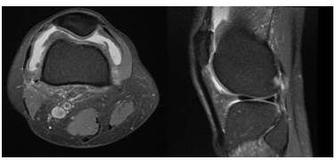 RM de rodilla derecha ponderaci&oacute;n DP FS: En corte axial (A) y sagital (B), se observa engrosamiento heterog&eacute;neo, difuso, de toda la membrana sinovial a predominio del compartimiento interno dado por la presencia de m&uacute;ltiples im&aacute;genes pseudo-nodulares, midiendo la mayor de ellas en su eje largo 2 cm ubicada en el compartimiento anterior y externo, coexistiendo con la presencia de l&iacute;quido sinovial intra-capsular sin intensidades hem&aacute;ticas en su interior, asimismo, se observa l&iacute;quido abundante en la bursa supra-patelar.