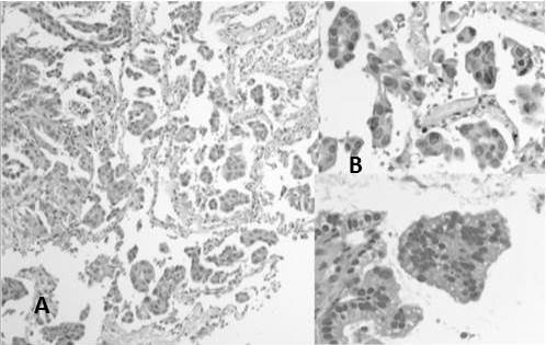 ADC patr&oacute;n micropapilar: A. Las c&eacute;lulas tumorales crecen en estructuras moruliformes que&rdquo; flotan&rdquo; dentro de espacios alveolares (H-E 10X). B-C. Las estructuras carecen de eje fibrovascular y las c&eacute;lulas muestran atipia citol&oacute;gica leve. (H-E 40X)