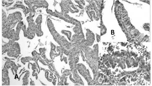 ADC patr&oacute;n papilar: A. La lesi&oacute;n crece a lo largo de ejes fibrovasculares (H-E 10X). B-C: Las c&eacute;lulas revisten un tallo con vaso central (H-E 40X).