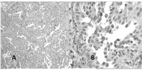 ADC patr&oacute;n predominantemente lep&iacute;dico: A. Las c&eacute;lulas tumorales crecen a lo largo de la superficie alveolar (H-E 10X). B. Las c&eacute;lulas son altas en tachuela de minero similares a las c&eacute;lulas de Clara (H-E 40X).