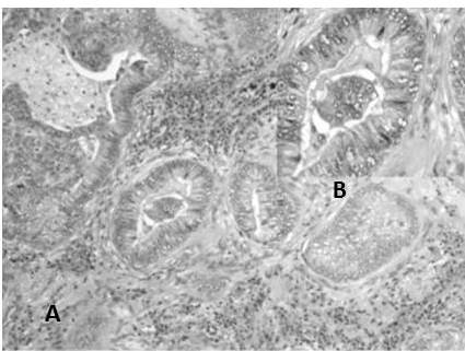 ADC con diferenciaci&oacute;n ent&eacute;rica: A. Estructuras glandulares de patr&oacute;n cribriforme (H-E 10X). B. Las c&eacute;lulas presentan pseudo-estratificaci&oacute;n, cromatina abierta y nucl&eacute;olo prominente (H-E 40X).