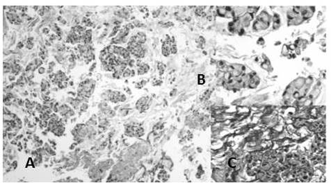 ADC mucinoso: A. Las c&eacute;lulas flotan en lagos de mucina (H-E 4X). B. Se observan c&eacute;lulas en anillo de sello (H-E 10X). C. Con la reacci&oacute;n de PAS se pone en manifiesto la mucina intra y extra-citoplasm&aacute;tica.