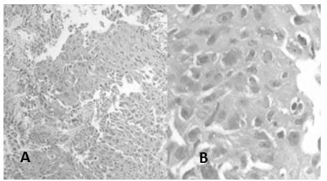 Carcinoma de c&eacute;lulas escamosas poco diferenciado: A. C&eacute;lulas de aspecto escamoso que se disponen en s&aacute;banas (H-E 10X). B. Ausencia de queratinizaci&oacute;n, presencia de disqueratinocitos (H-E 40X).
