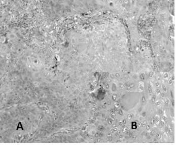 Carcinoma de c&eacute;lulas escamosas bien diferenciado: A. C&eacute;lulas de aspecto escamoso que se disponen en s&aacute;banas (H-E 10X). B. Prominente queratinizaci&oacute;n individual y formaci&oacute;n de remolinos c&oacute;rneos (H-E 40X).