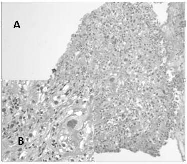 Carcinoma de c&eacute;lulas escamosas moderadamente diferenciado: A. C&eacute;lulas de aspecto epitelial con atipias que se disponen en s&aacute;banas (H-E 10X). B. Presencia de material eos&iacute;nof&iacute;lico laminar extracelular correspondiente a queratina (H-E 40X).