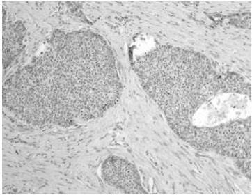 Carcinoma de c&eacute;lulas escamosas basaloide: la lesi&oacute;n crece en islas con empalizada perif&eacute;rica, algunas islas presentan comedo-necrosis, las c&eacute;lulas de la periferia son m&aacute;s peque&ntilde;as con alta relaci&oacute;n n&uacute;cleo citoplasma, hacia el centro de las islas las c&eacute;lulas presentan citoplasma m&aacute;s amplio. (H-E 10X).