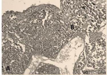 Carcinoma neuroendocrino de c&eacute;lulas peque&ntilde;as: A. La lesi&oacute;n crece por debajo del epitelio bronquial (H-E 4X). B. Son c&eacute;lulas redondas peque&ntilde;as indiferenciadas (H-E 40X).
