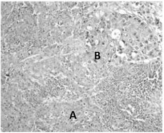 Carcinoma neuroendocrino de c&eacute;lulas grandes: A. Lesi&oacute;n s&oacute;lida acompa&ntilde;ada de infiltrado inflamatorio de tipo linfoplasmocitario (H-E 4X). B. Son c&eacute;lulas grandes, los n&uacute;cleos presentan cromatina en sal y pimienta (H-E 40X).