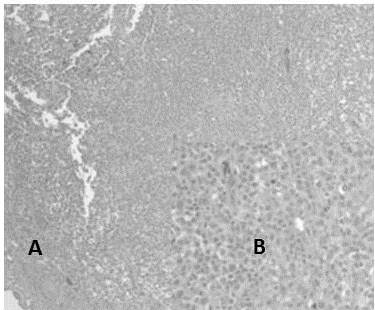 Tumor carcinoide t&iacute;pico: A Lesi&oacute;n hipercelular solida dividida por vasos sangu&iacute;neos de paredes delgadas (H-E 4X). B C&eacute;lulas con escasa atipia l&iacute;mites citoplasm&aacute;ticos bien definidos (H-E 40X).